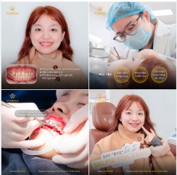 NIỀNG RĂNG MẮC CÀI KIM LOẠI, TÌM LẠI CƠ HỘI MỚI CHO NỤ CƯỜI