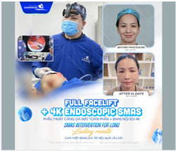 Bạn có biết…Lão hóa không chỉ nằm ở làn da bên ngoài, mà bắt nguồn từ sự chùng nhão của tầng cơ SMAS – lớp cấu trúc nâng đỡ toàn bộ gương mặt.