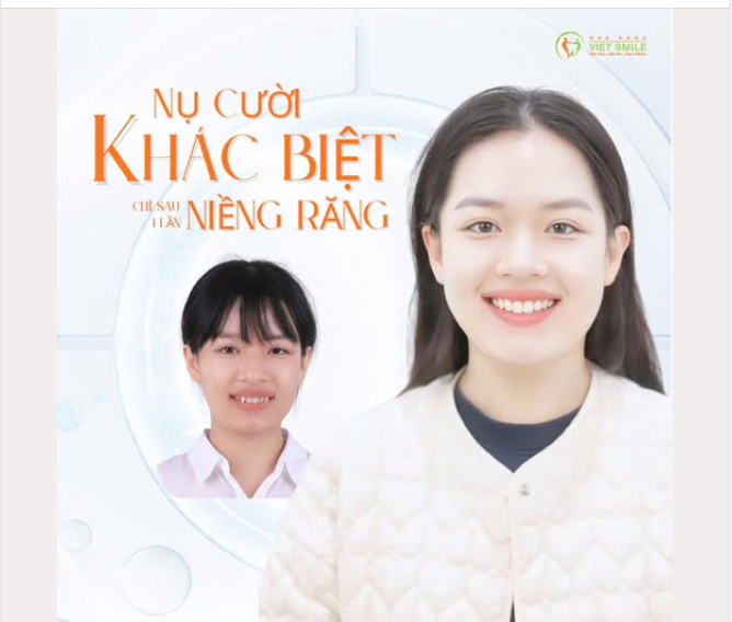 NỤ CƯỜI KHÁC BIỆT – CHỈ SAU 1 LẦN NIỀNG RĂNG