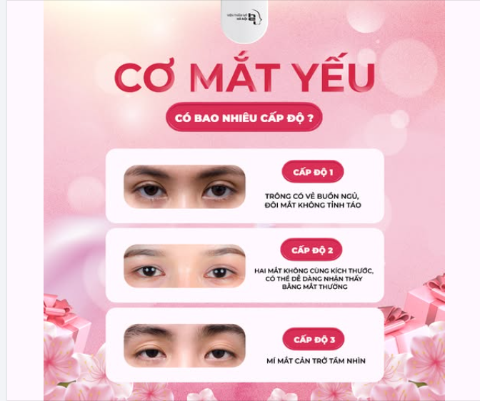 CƠ MẮT YẾU CÓ BAO NHIÊU CẤP ĐỘ?