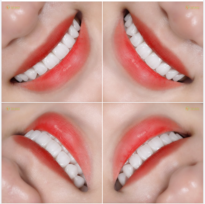 MẶT DÁN SỨ VENEER – LỰA CHỌN NHẸ NHÀNG CHO NỤ CƯỜI TINH TẾ