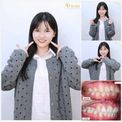 TẠM BIỆT RĂNG HÔ – ĐÓN NỤ CƯỜI TỰ TIN CÙNG CÔ BÁC SĨ TƯƠNG LAI