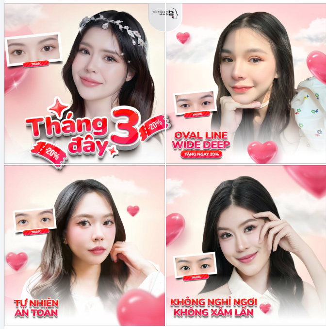 Mắt xinh – Xu hướng nhấn mí đang được yêu thích