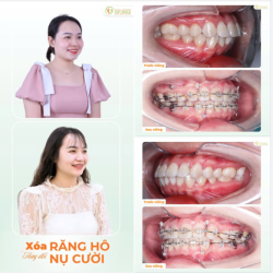 “NIỀNG RĂNG ĐI EM, DO DỰ TRỜI TỐI MẤT”