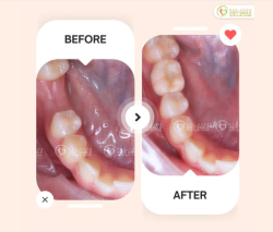 MẤT RĂNG SỐ 6 - ĂN NHAI KHÓ KHĂN, ĐỪNG ĐỂ LÂU HỎNG CẢ HÀM