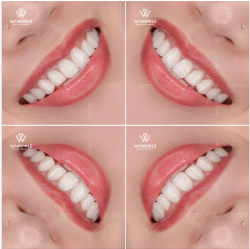 THIẾT KẾ NỤ CƯỜI TỰ NHIÊN, GIỮ TRỌN CHẤT RIÊNG