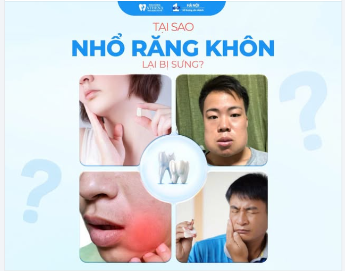 NHỔ RĂNG KHÔN XONG MẶT SƯNG NHƯ "NGẬM KẸO" – NỖI ÁM ẢNH CỦA BẠN?