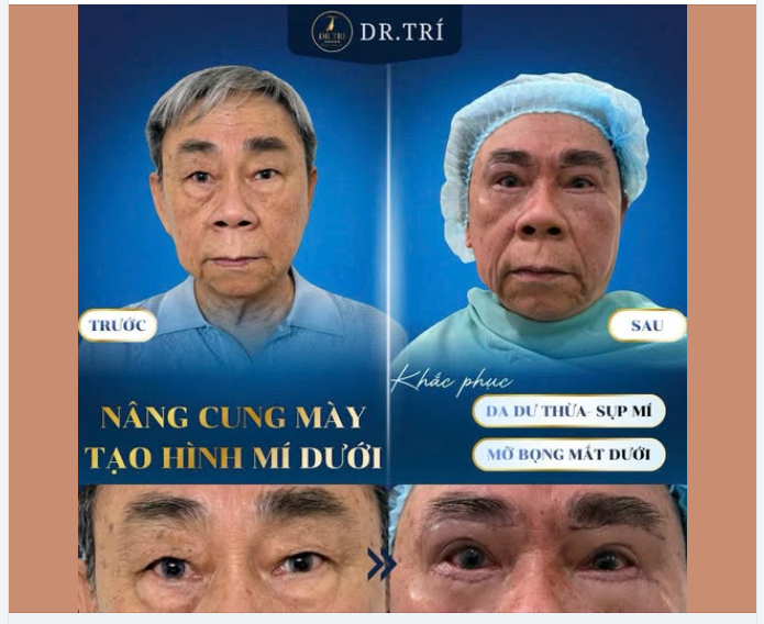 TẠM BIỆT MẮT SỤP – ĐÓN DIỆN MẠO MỚI