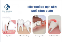 NHỔ RĂNG KHÔN (RĂNG SỐ – KHI NÀO CẦN CAN THIỆP?