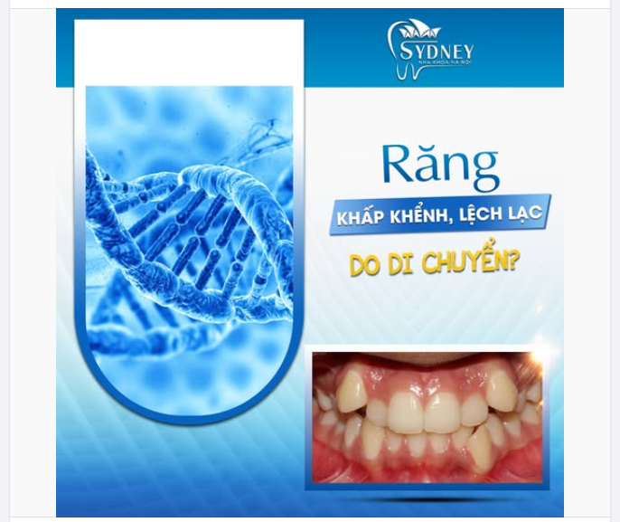 RĂNG KHẤP KHỂNH, LỆCH LẠC CÓ PHẢI DO DI TRUYỀN?