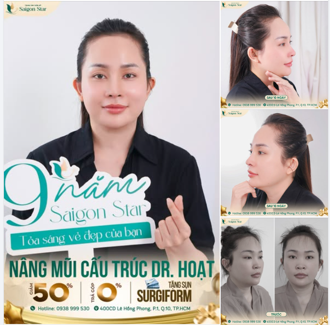 MŨI ĐẸP NGAY SAU KHI THÁO NẸO