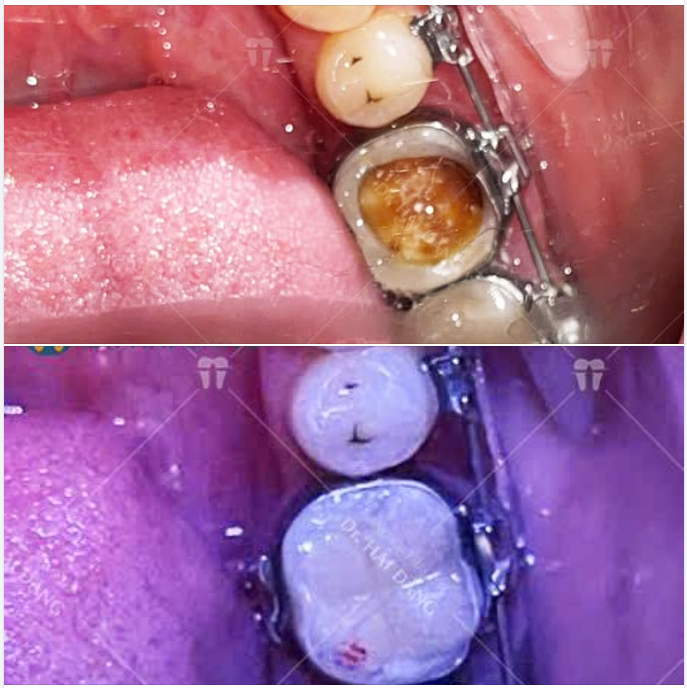 RĂNG SÂU LỚN KHI ĐANG NIỀNG – XỬ LÝ NHƯ THẾ NÀO?