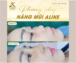 “Trộm vía” cơ địa đẹp nên chỉ sau 1 tuần nâng mũi Aline, nàng đã sở hữu dáng mũi cao thanh, form mềm mại thấy rõ