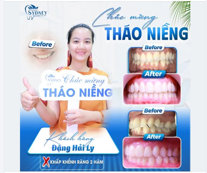 CHÚC MỪNG KH. HẢI LY ĐÃ THÁO NIỀNG THÀNH CÔNG