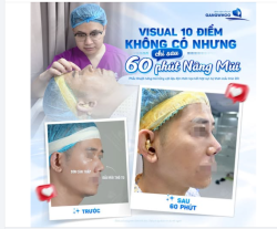 Nhiều khách hàng đang tự ti vì sống mũi thấp tẹt, góc mũi trán thấp, đầu mũi thô to làm góc nghiêng kém sắc? Đừng để khuyết điểm nhỏ "dìm" đi phong độ nam thần của mình!