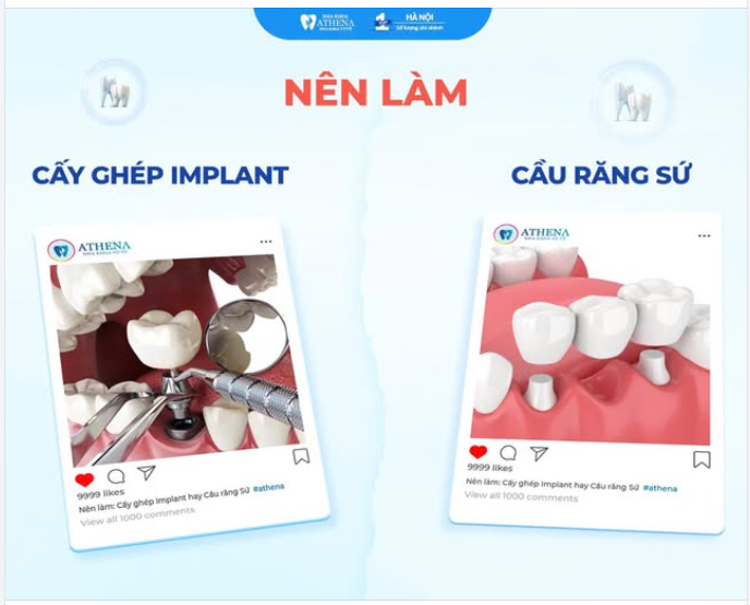 MẤT RĂNG THÌ NÊN CHỌN TRỒNG RĂNG IMPLANT HAY LÀM CẦU RĂNG SỨ?