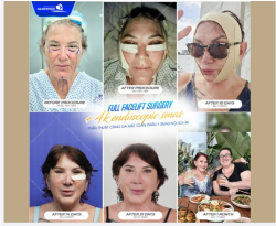 Ở tuổi 63, Mrs.B từ Australia đến Việt Nam với mong muốn khi tìm đến Bệnh viện thẩm mỹ Gangwhoo: