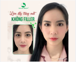 Trẻ hóa vùng mắt KHÔNG CẦN FILLER