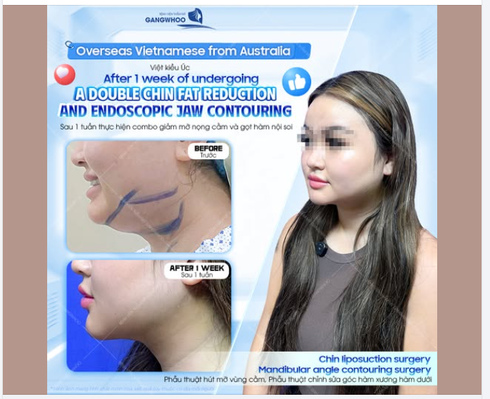Vượt hàng ngàn cây số từ Úc trở về, chị khách của chúng tôi mang theo mong muốn cải thiện những khuyết điểm vùng mặt.