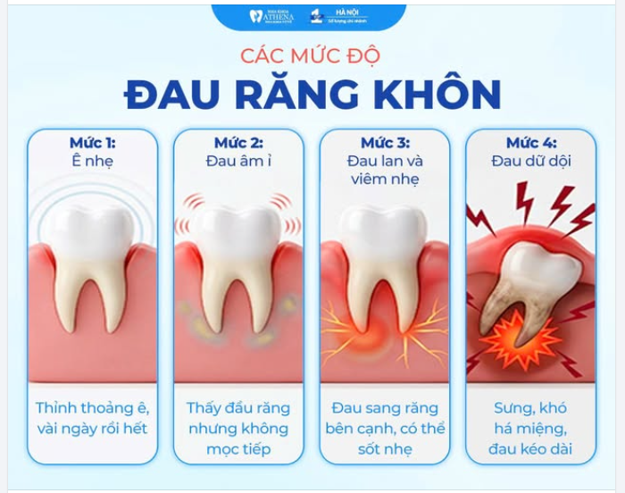 CÁC MỨC ĐỘ ĐAU RĂNG KHÔN – BẠN ĐANG Ở GIAI ĐOẠN NÀO?