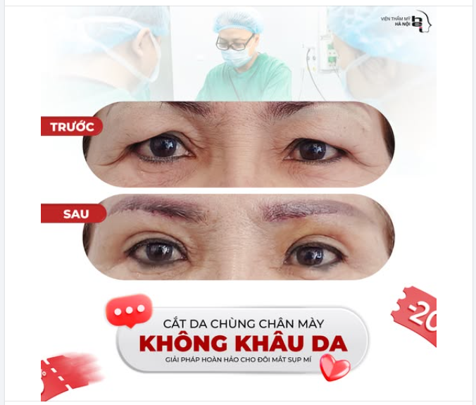 Bạn có biết tác hại của hiện tượng Da chùng chân mày