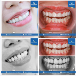 Tác dụng phụ khi làm răng sứ và phác đồ tái tạo nụ cười