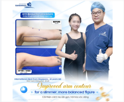 Sau khi dành thời gian tìm hiểu, cô lựa chọn Gangwhoo với mong muốn cải thiện vùng cánh tay theo hướng tự nhiên, phù hợp với cơ thể.