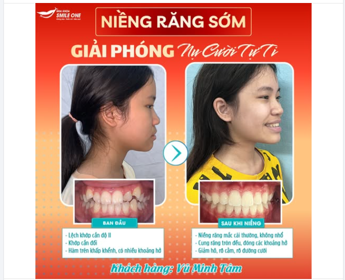 Chị kể, nhìn con cười vẫn dễ thương. Chỉ là… răng không đều lắm.