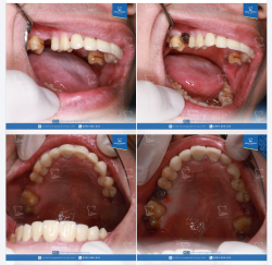 Implant không chỉ phục hình răng bị mất mà còn: