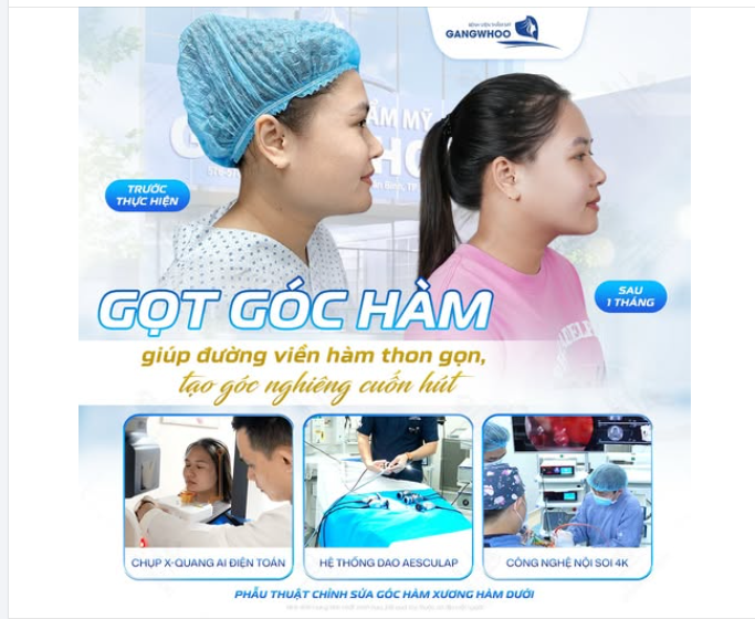 GỌT GÓC HÀM GIÚP ĐƯỜNG VIỀN HÀM THON GỌN