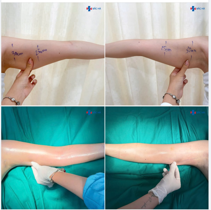 HÚT MỠ CÁNH TAY – GIẢM NGAY 40% KÈM ƯU ĐÃI HẤP DẪN