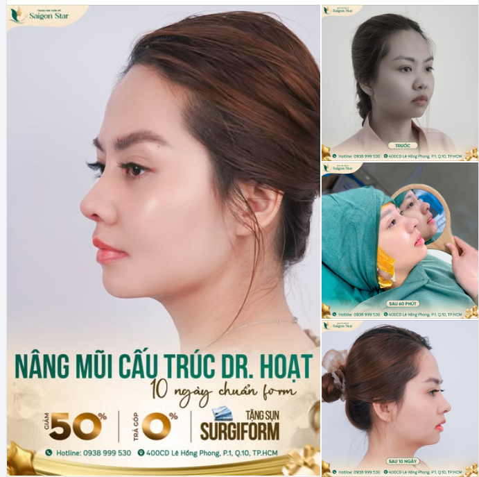 NÂNG MŨI CẤU TRÚC DR. HOẠT - CHUẨN FORM SAU 10 NGÀY