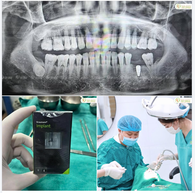 Ngày cuối tuần của Viet Smile khép lại bằng một ca cấy Implant Straumann (Thụy Sỹ) với kết quả hoàn mỹ