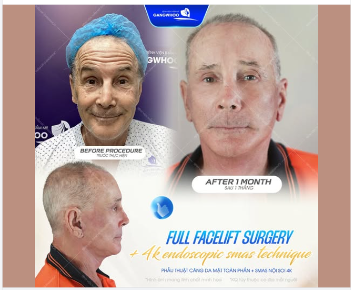 Phẫu thuật căng da mặt toàn phần + Smas nội soi 4K tại bệnh viện thẩm mỹ Gangwhoo đỉnh cao trẻ hóa dành cho nam giới: