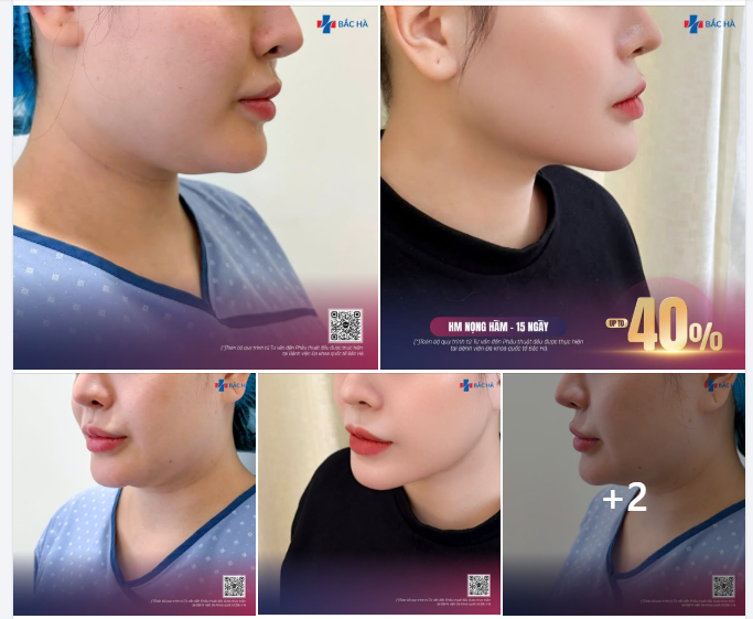 Một vùng rất nhỏ dưới cằm  Nhưng lại quyết định độ “gọn” của cả gương mặt