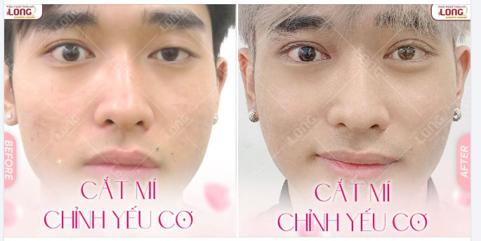Đây là một trường hợp mắt bị lỗi nặng cụ thể là: “MẮT BỊ YẾU CƠ” sau khi được chỉnh sửa