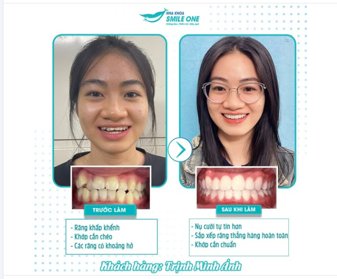 NIỀNG KHÔNG CHỈ ĐỂ ĐẸP – MÀ ĐỂ ĐÚNG