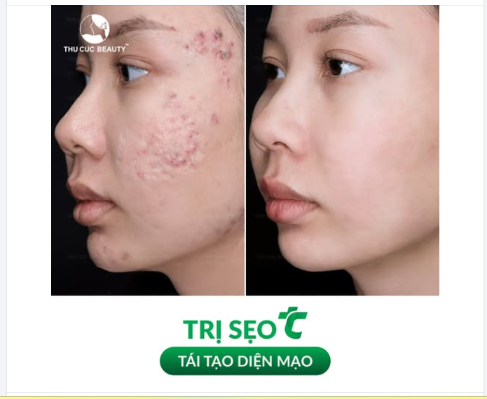 ĐÁNH BAY SẸO RỖ - TỰ TIN "SHOW" MẶT MỘC. CHỌN TRỊ SẸO TC!