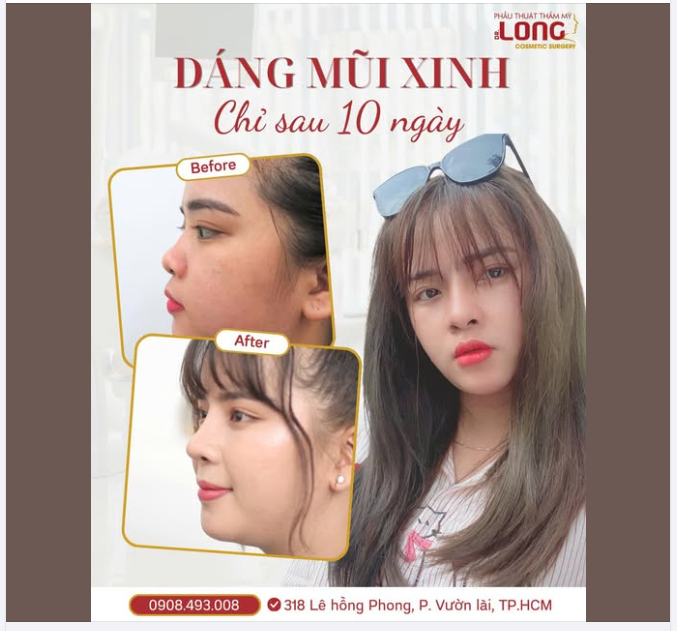 Đắn đo nhiều năm mới đi đến quyết định NÂNG MŨI  Vừa may ngay lúc đang có trợ giá trong tháng 4 này