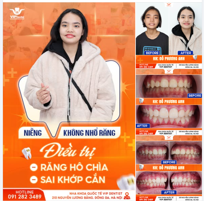 TẠM BIỆT RĂNG HÔ - TỰ TIN TỎA NẮNG