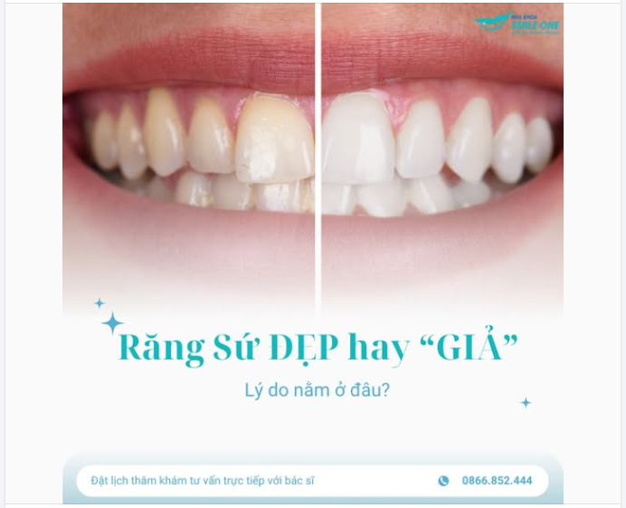 80% khách hàng đến Nha khoa Smile One để sửa lại răng sứ cũ đều với một lý do là "Trông giả quá".