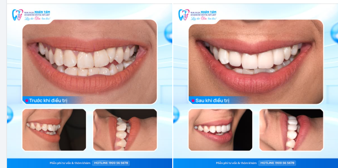Nụ cười tự nhiên sau khi làm răng sứ – Nhìn như chưa từng can thiệp