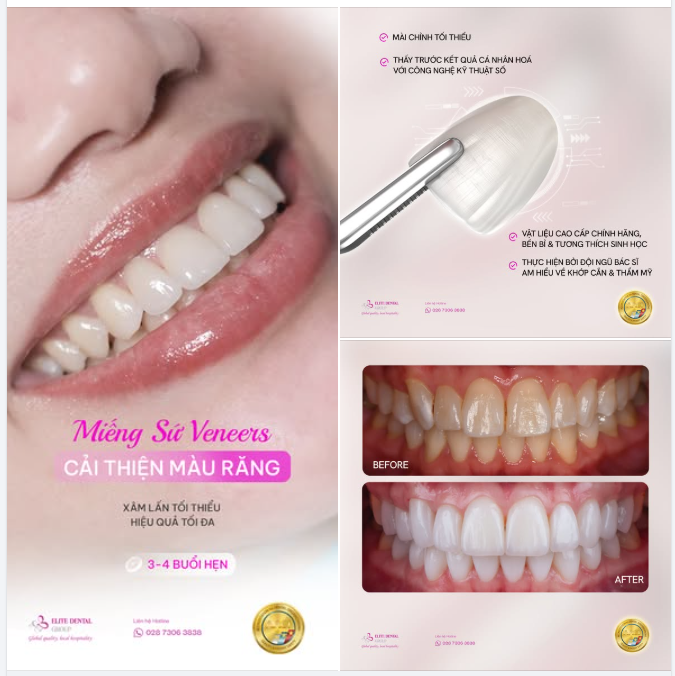 KHẮC PHỤC RĂNG Ố VÀNG LÂU NĂM BẰNG DÁN SỨ VENEERS