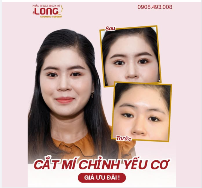 MẮT YẾU CƠ LÀ GÌ?  Mắt yếu cơ lâu năm có sửa lại được không?  Hiệu quả như thế nào?