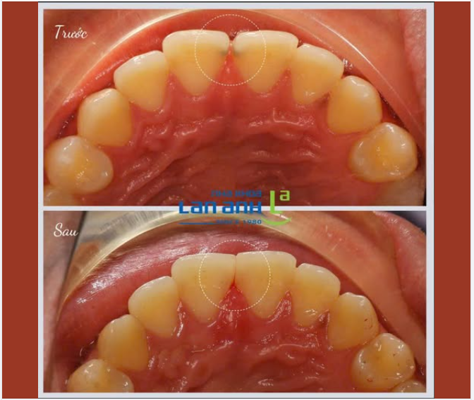 Kẽ răng cửa thưa – dễ gây sâu răng