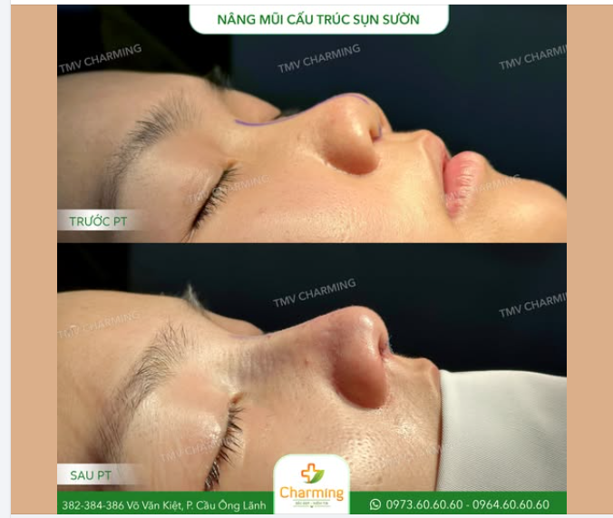 Với phương pháp nâng mũi cấu trúc sụn sườn tình trạng đầu mũi thô to, trụ mũi ngắn của nàng khách đã được khắc phục triệt để.