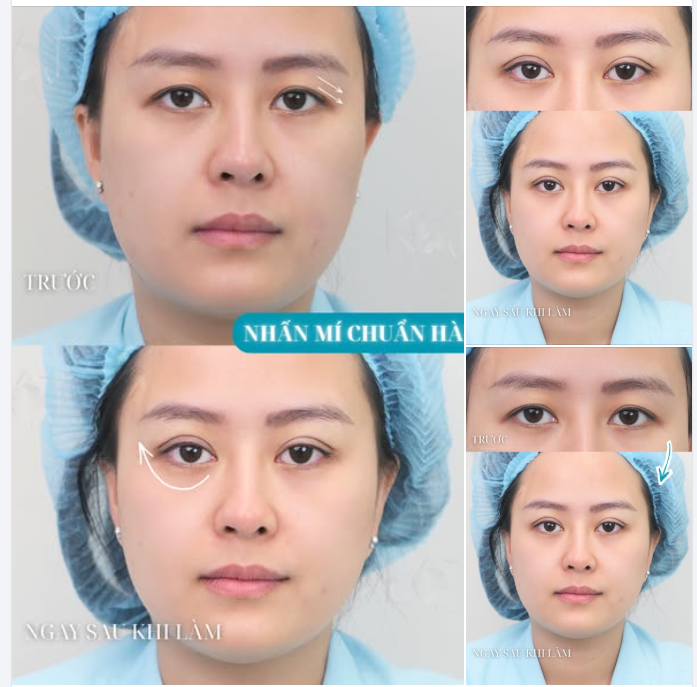 DA DƯ– SỤP MÍ giờ không còn là chuyện của tuổi U40 nữa… mà đang trẻ hoá từng ngày