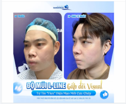 ĐỘ MŨI L-LINE - GẤP ĐÔI VISUAL
