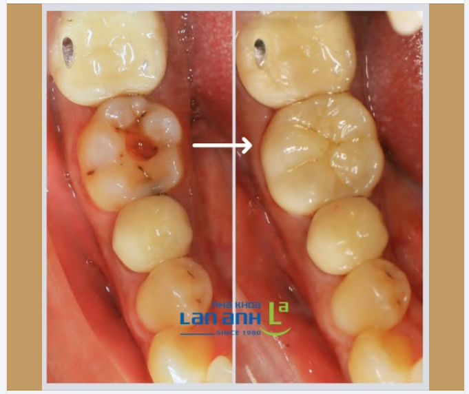 Phục hình răng – tái tạo hình thể tự nhiên