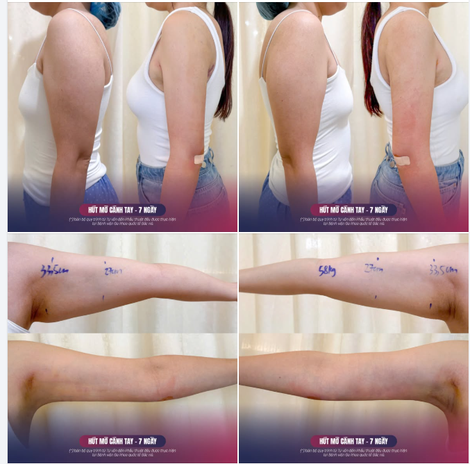 ƯU ĐÃI THÁNG 4  Giảm đến 40% chi phí hút mỡ cánh tay